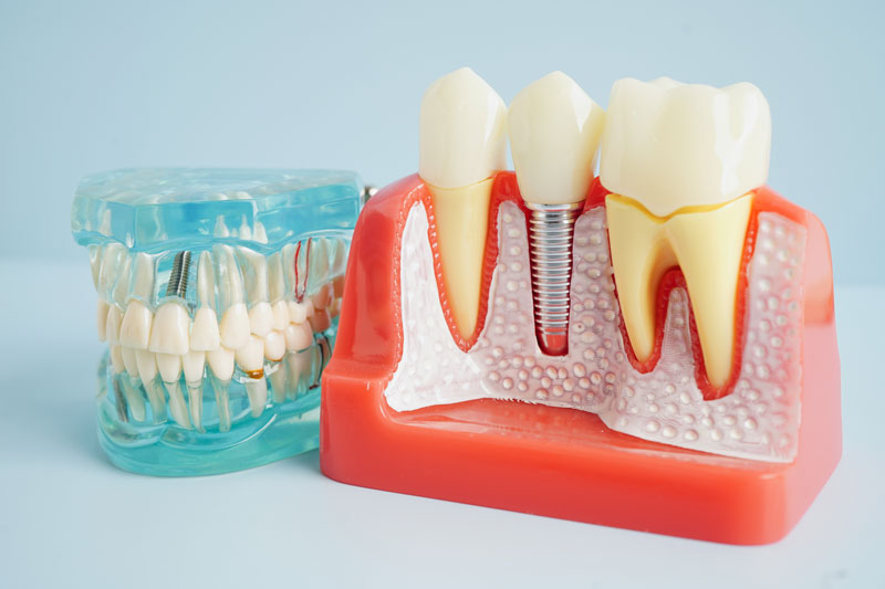 a cut away of the jaw with a dental implant and a full arch of teeth next to it